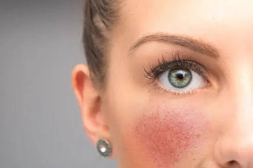 Natural rosacea skincare products for sensitive skin, handmade in Ireland by Natures Alchemy